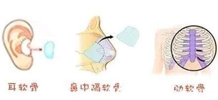 自体软骨隆鼻常用的三个软骨