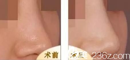 自体软骨隆鼻真人前后对比案例