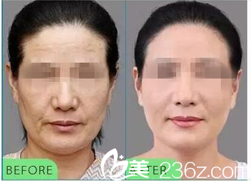 去法令纹前后对比