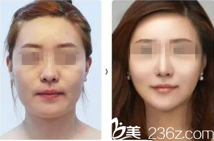 哈尔滨去法令纹真人案例