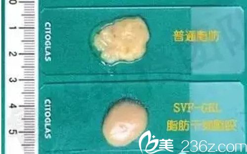 普通脂肪VS脂肪胶质地对比