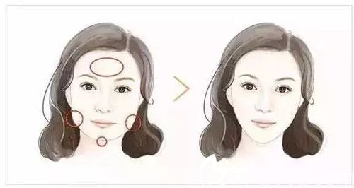 脂肪胶填充恢复期