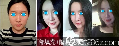 济源萍面部填充和隆鼻案例 济源萍面部填充和隆鼻案例