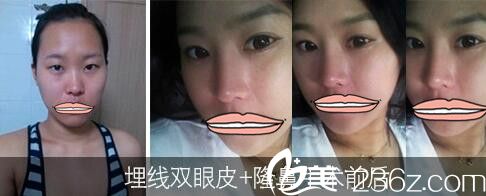 济源萍双眼皮和隆鼻案例 济源萍双眼皮和隆鼻案例