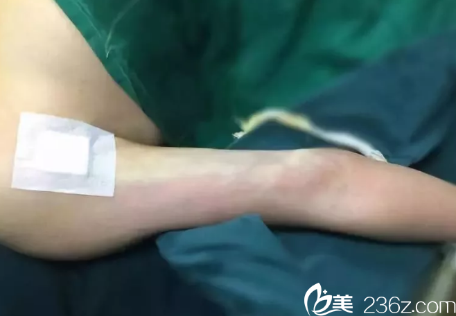 吸脂瘦手臂术后即刻