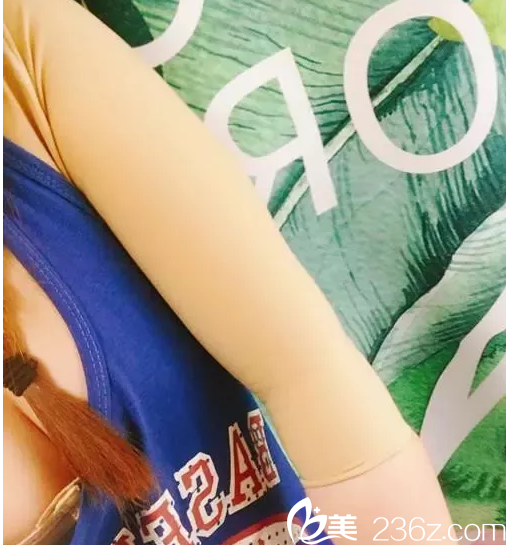 手臂吸脂半个月恢复