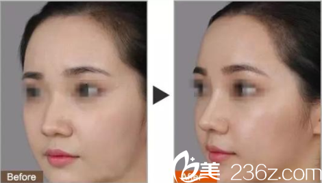衡阳美莱隆鼻前后对比照片