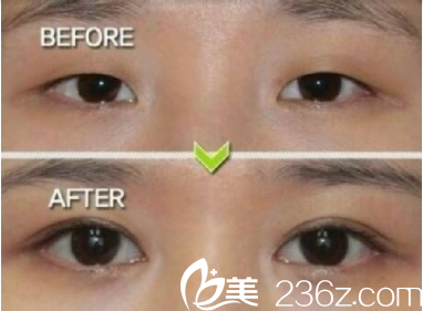 衡阳美莱双眼皮前后对比