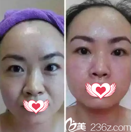 做完激光除皱后效果案例