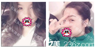 包头叶子整形埋线双眼皮案例 包头叶子整形埋线双眼皮案例