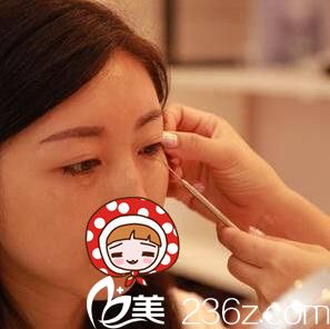 做内切祛眼袋术前面诊