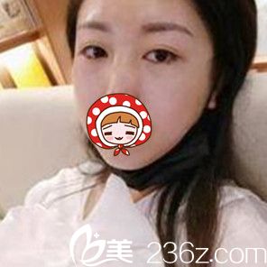 做内切祛眼袋术后即刻<span style=