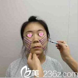 在北京叶美人做面部提升设计照