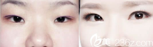 北京美莱整形美容医院刘金华眼综合手术效果对比图 北京美莱整形美容医院刘金华眼综合手术效果对比图