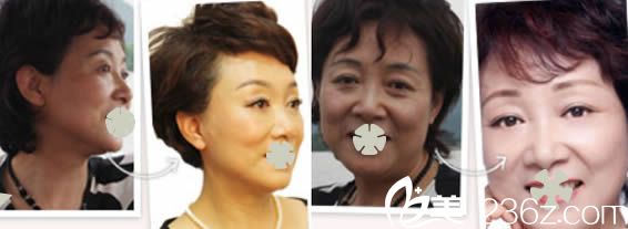 北京美莱向淑英医生注射美肤效果对比图 北京美莱向淑英医生注射美肤效果对比图