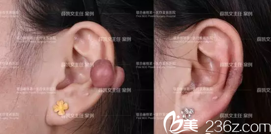 北京联合丽格薛凯文去疤痕疙瘩案例