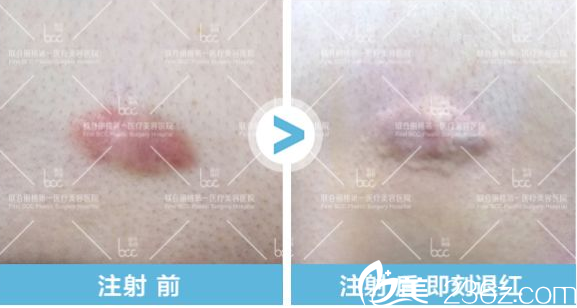 北京联合丽格薛凯文疤痕针注射前后效果