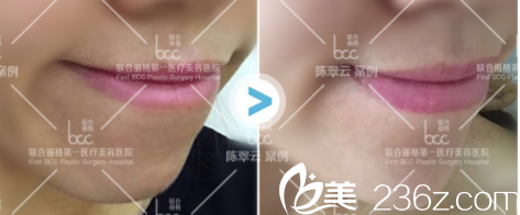 北京联合丽格陈翠云玻尿酸丰下巴案例