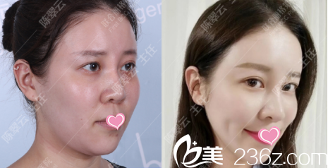 北京联合丽格陈翠云线雕下颌缘提升案例