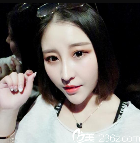 在深圳军科整形医院做完鼻子两个月效果图