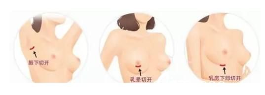 假体丰胸的手术切口