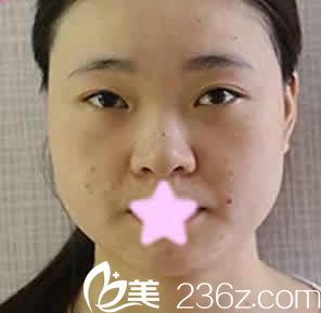 我在大同美神整形打瘦脸之前的照片 我在大同美神整形打瘦脸之前的照片