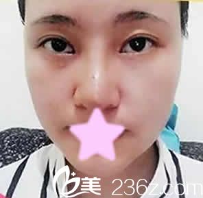 我在大同美神注射瘦脸后第3天照片 我在大同美神注射瘦脸后第3天照片