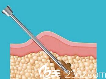 吸脂减肥手术过程示意
