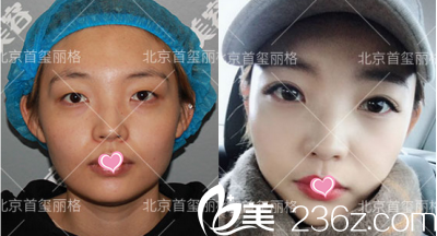 北京首玺丽格双眼皮术前术后对比效果