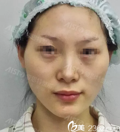 术前面部凹陷严重 术前面部凹陷严重