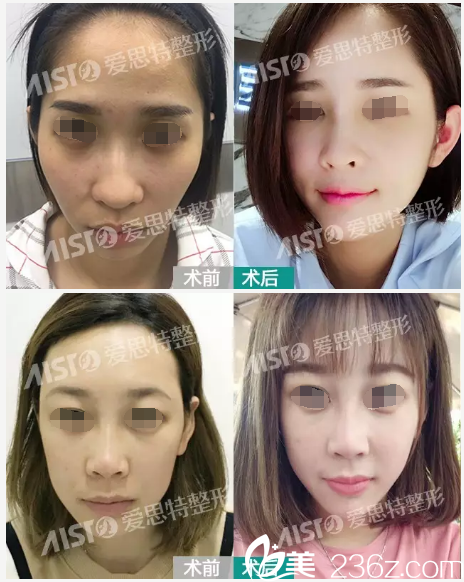 程宁新院长脂肪填充案例 程宁新院长脂肪填充案例