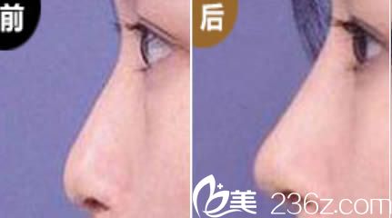 长沙爱思特整形假体隆鼻效果对比图