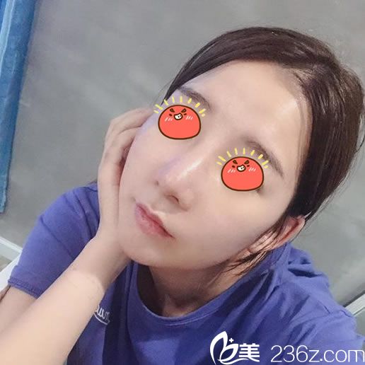 做完肋软骨隆鼻7天拆线<span style=