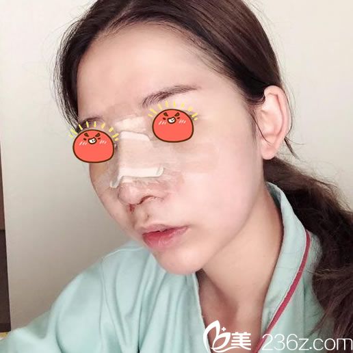 做完鼻综合隆鼻手术3天图片