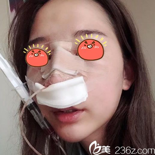 宁波薇琳张文巍隆鼻手术当天照片