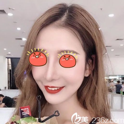 做完肋软骨隆鼻30天恢复图片