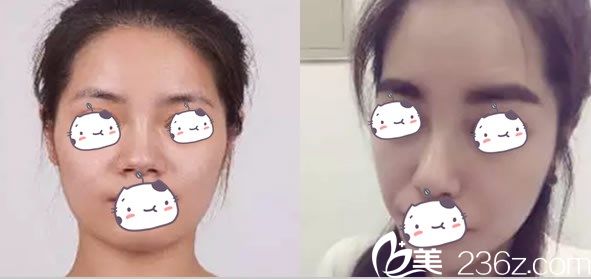 佛山华美整形罗玉康医生鼻部整形前后效果图