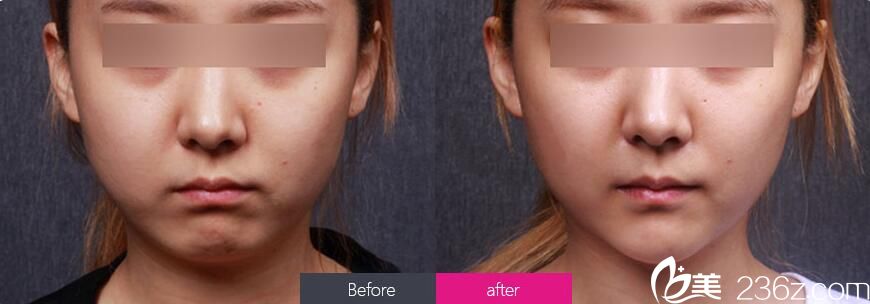 武汉亚韩硅胶假体垫下巴前后对比案例