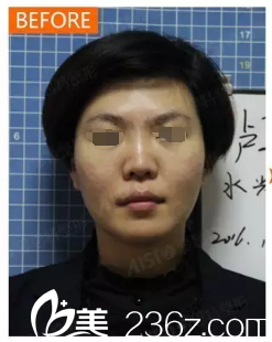 术前皮肤暗沉发黄 术前皮肤暗沉发黄