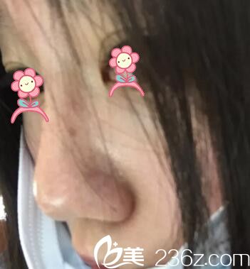 郑州丽天玻尿酸注射隆鼻术后2天