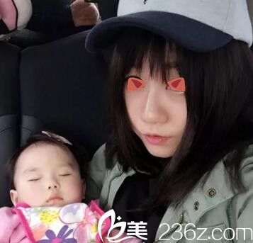 郑州丽天玻尿酸注射隆鼻术后31天