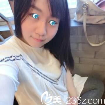 郑州丽天玻尿酸注射隆鼻术后36天