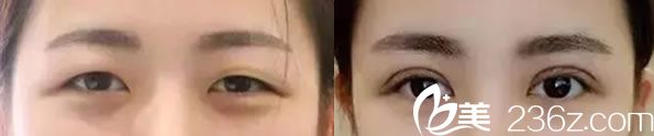 雷朝勇医生全切双眼皮代表案例