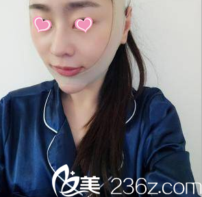在北京叶美人做面部吸脂第4天效果