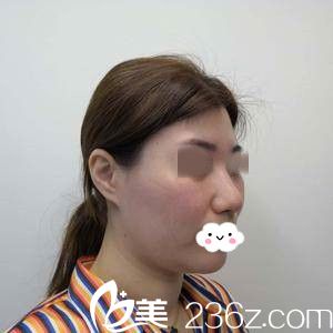 手术前的我 手术前的我