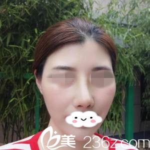 术后一周 术后一周