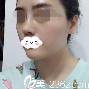 肋软骨隆鼻半个月