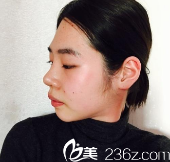 在广州曙光整形医院做脂肪填充手术前 在广州曙光整形医院做脂肪填充手术前