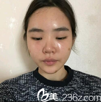 广州曙光自体脂肪填充术后三天 广州曙光自体脂肪填充术后三天