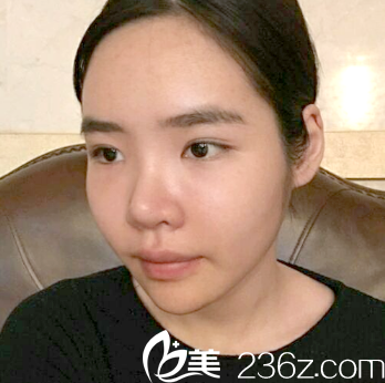 广州曙光自体脂肪填充术后7天效果 广州曙光自体脂肪填充术后7天效果